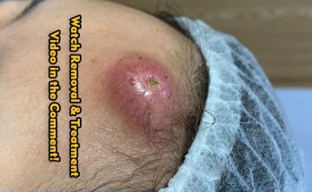 What’s Causing This Cyst?