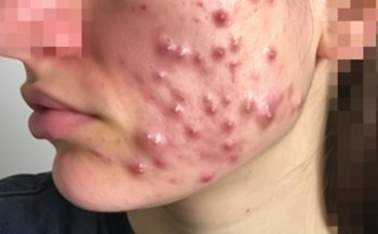 What cause Cystic Acne & Treatment 