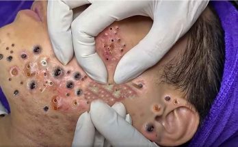 6 Ways to Get Rid of Pimples Fast, Blackheads removal (video tip)