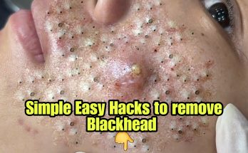 Simple Easy Hacks to Remove Blackheads on Nose