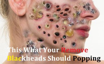 What Is the Best Way to Pop a Pimple?