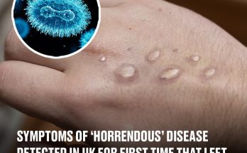 Doctor reveals symptoms of ‘horrendous’ disease detected in UK for first time that left patient ‘unable to move or eat’